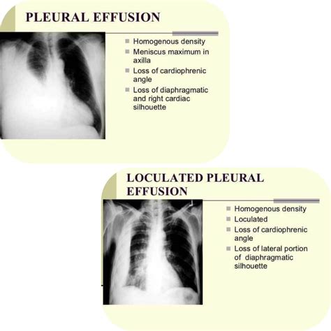 Supine Chest X Ray Pleural Effusion at Mason Fuller blog