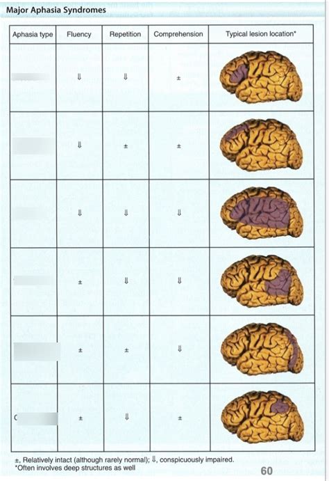 Image result for Conduction Aphasia