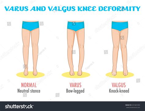 Varus Vs Valgus Fracture