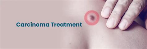 Find Top Carcinoma Treatments in Hyderabad