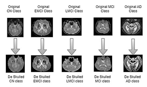 A Convolutional Mixer-Based Deep Learning Network for Alzheimer’s ...