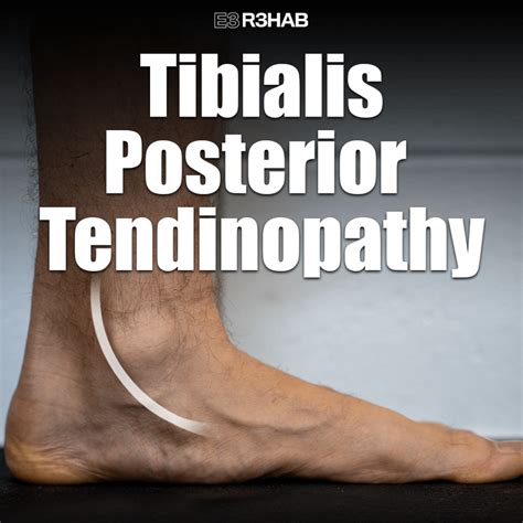 How To Get Rid Of Posterior Tibial Tendonitis at Ryder Sidaway blog