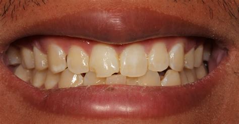 Dental Bonding In NYC | Before And After Photos
