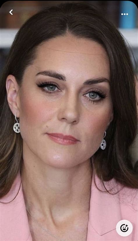 Kate middleton has a face scar from a childhood operation – Artofit
