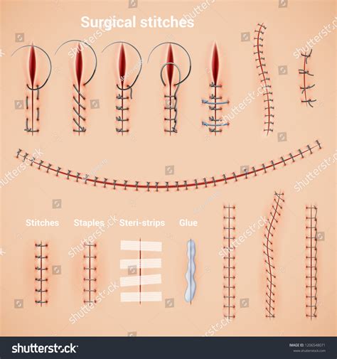 1,083件の「Surgical staples」の画像、写真素材、ベクター画像 | Shutterstock