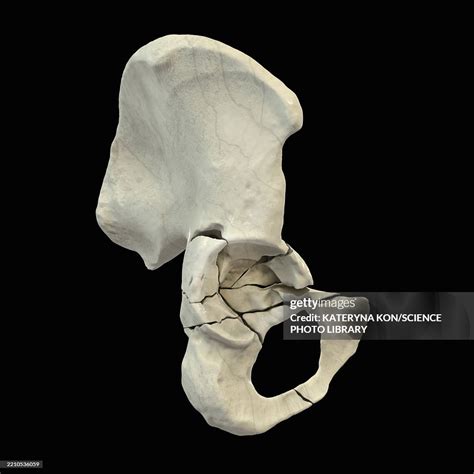 Acetabulum Fracture Illustration High-Res Vector Graphic - Getty Images