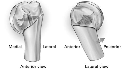 The pattern of the fracture and displacement of the fragments predict the outcome in proximal ...