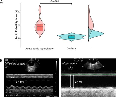 The Aortic Pulsatility Index: A New Sign of Severe Acute Aortic Regurgitation - Journal of the ...