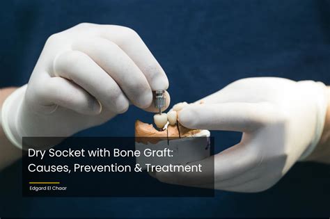 Dental Bone Graft Dry Socket at Ronald Mulligan blog