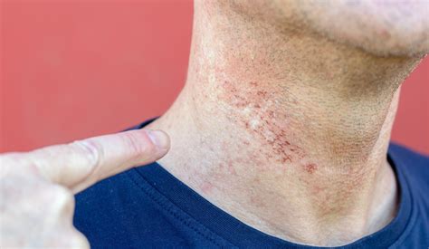 How To Prevent Razor Bumps On Neck » Rainparticular