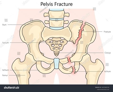 Pelvic Pelvis Fracture Structure Diagram Hand Stock Vector (Royalty Free) 2422585743 | Shutterstock