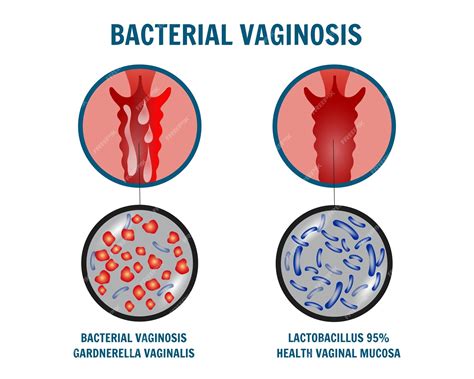 Infografía de vaginosis bacteriana en ilustración vectorial | Vector ...