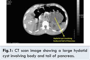 Pancreatic Hydatid Cyst Managed Successfully by Internal Drainage