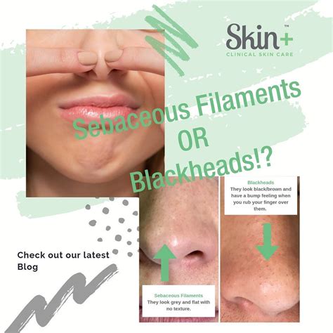 Dermatologists explain how to get rid of sebaceous filaments in the nose and other areas, as ...