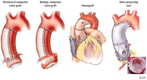 Aortic replacement in cardiac surgery | MDedge