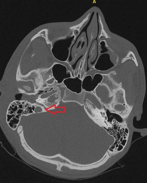 Apex Of Petrous Temporal Bone - petrous temporal bone