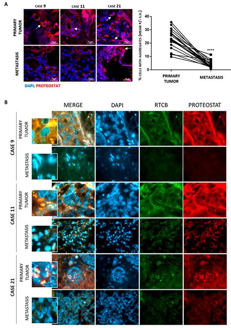 Protein Aggregation Patterns Inform about Breast Cancer Response to ...