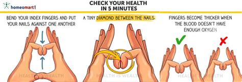 Homeopathy for Blood Circulation | Remedies for Varicose Veins ...