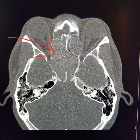Ct Scan Of Sinuses at Mara Marr blog