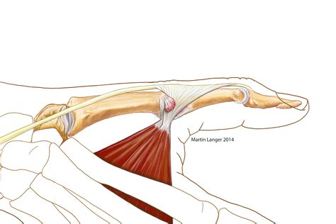 Ulnar Collateral Ligament Tear With Stener39s Lesion A Ulnar