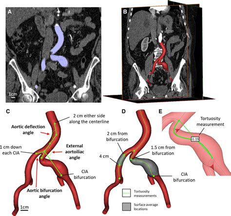 Morphology and Hemodynamics in Isolated Common Iliac Artery Aneurysms ...