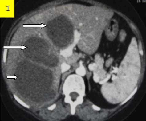 Multiple amoebic liver abscesses with characteristic anchovy sauce ...