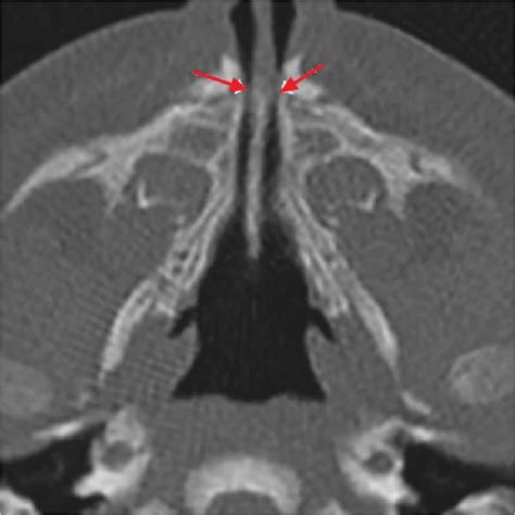 Congenital pyriform aperture stenosis causes, symptoms, diagnosis & treatment