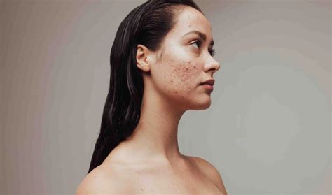 Effective Acne Scar Treatment in Pune – Minimize Scars with VLCC