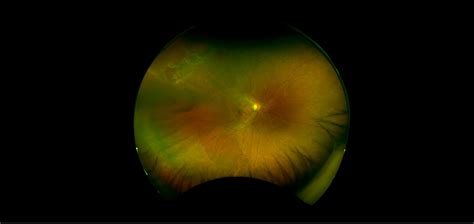 Operculated Retinal Hole In Retinal Detachment Retina