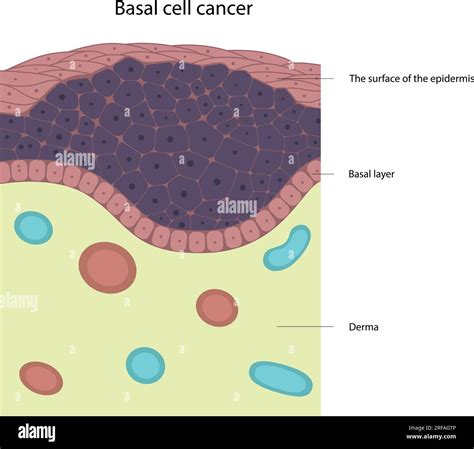 Skin Tumor Disease at Jacob Coffey blog
