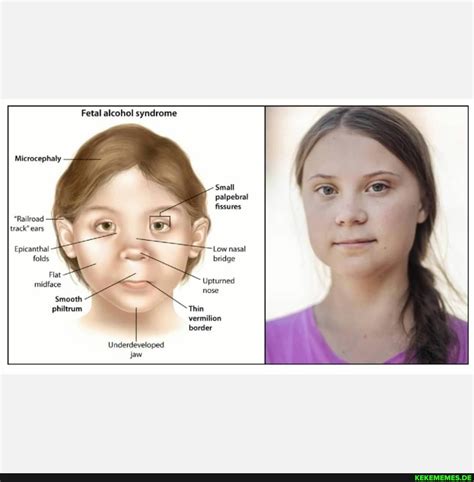 Fetal alcohol syndrome "Railroad track" ears Epicanthal folds Flat ...