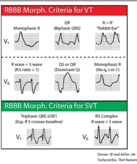 Idioventricular Rhythm Vs Junctional