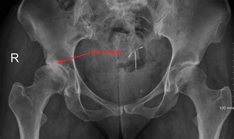 X Ray Pictures Of Hip Arthritis