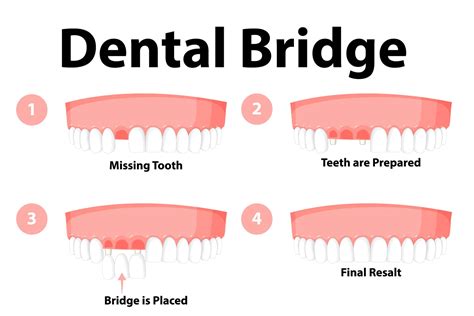 Dental Bridges Dentist in Potomac MD | Potomac Smiles Dental In Potomac MD