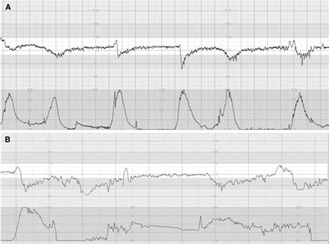 Pathophysiological interpretation of fetal heart rate tracings in ...