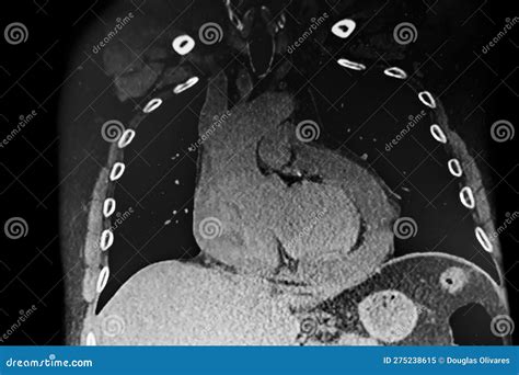 Chest CAT Scan Showing Pericardial Effusion. Stock Image - Image of internal, tomography: 275238615