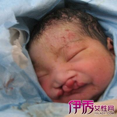 四维彩超及时筛出唇腭裂胎儿-杭州玛莉亚妇产医院