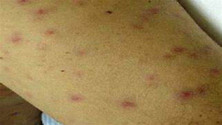Image result for typhus