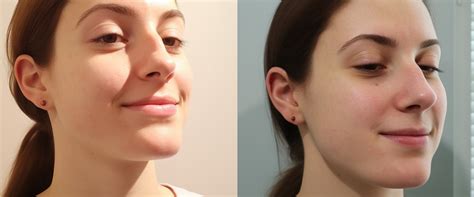 Image result for Cheekbones Reduction Book