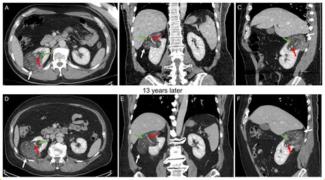 Active surveillance for large renal angiomyolipoma - The American Journal of the Medical Sciences