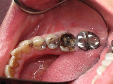 Root Canal Crown Color