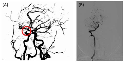 Early Diagnosis of Intracranial Internal Carotid Artery Stenosis Using ...