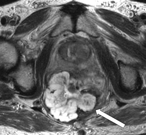 MRI of Rectal Cancer: Tumor Staging, Imaging Techniques, and ManagementRadioGraphics
