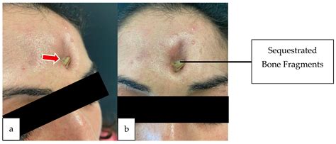 Pott’s Puffy Tumor: Two-Case Series and Contemporary Management Approach