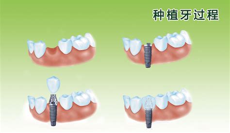 KQ011综合病理水晶牙列模型(32颗牙)-上海启沭医学仪器有限公司