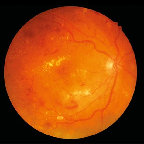 Diabète et œil - Médecine interne - Universimed - Knowledge that matters