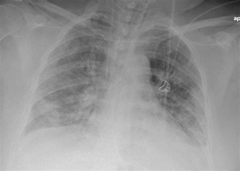 Chest X Ray Pulmonary Embolism at Makayla Hampton blog
