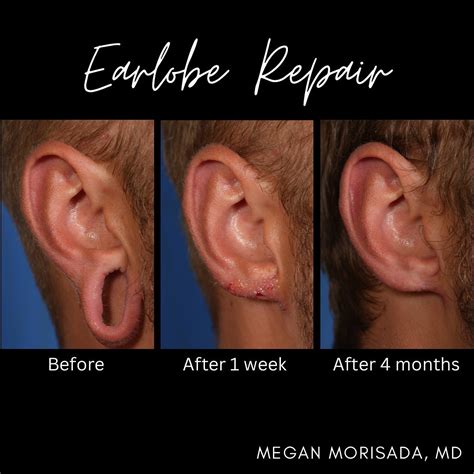 Stretched Earlobe Repair Surgery Following Gauge Earring Expert Split