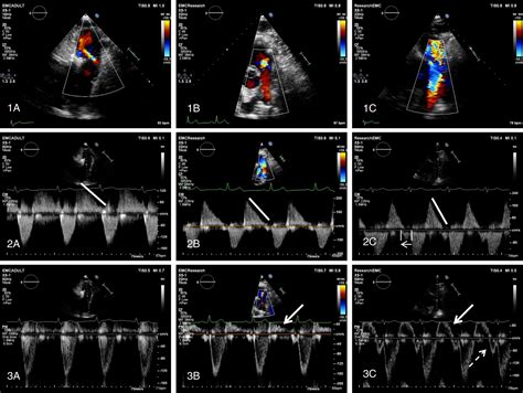 Echocardiographic parameters of severe pulmonary regurgitation after ...