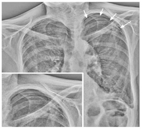 Portable Dynamic Chest Radiography: Literature Review and Potential ...
